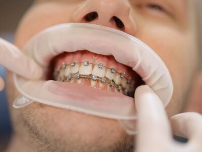 The Ultimate Guide to Orthodontic Treatments: What You Need to Know